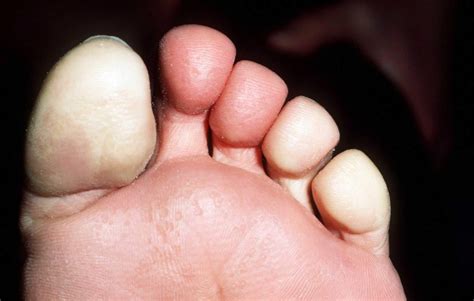 white feet|Raynaud Phenomenon 